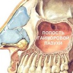 Гнойный гайморит лечение